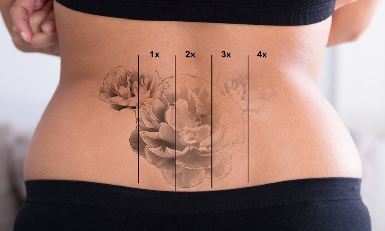 remove tattoos gradually