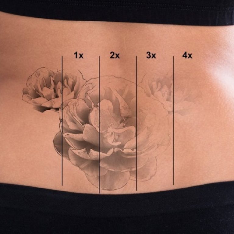 remove tattoos gradually